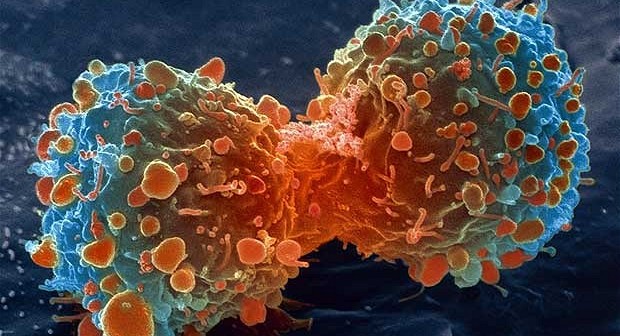 Curcumin Proven to ELIMINATE Stage-3 Myeloma Cancer