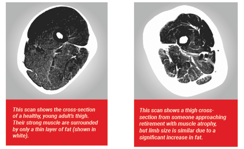 Week 22 (2019) – Sarcopenia Epidemic